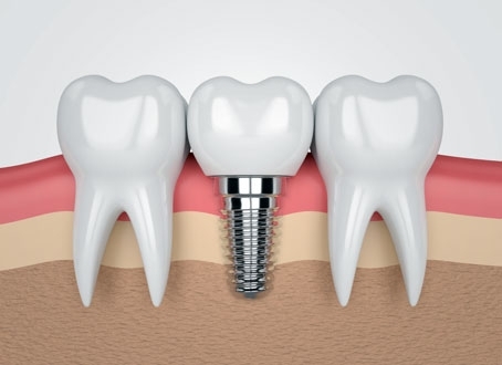 Dental Implant Prices 2025 Ankara