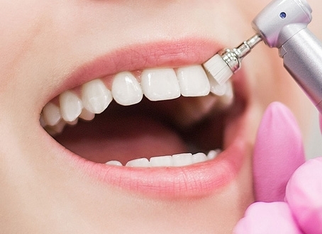 Dental Stone Cleaning Ankara